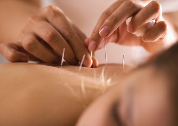 acupuncture treatment