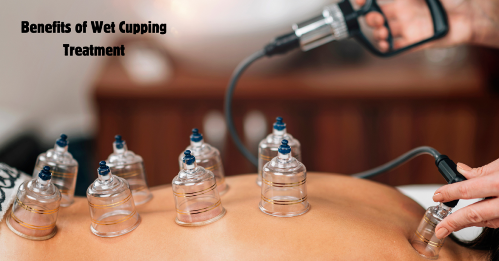 wet cupping treatment