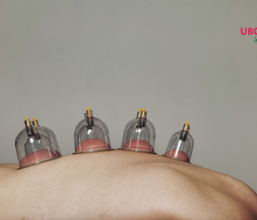 dry cupping therapy