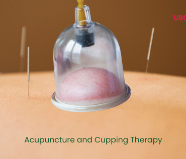 acupuncture and cupping therapy