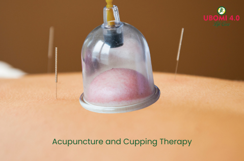 acupuncture and cupping therapy