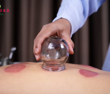 wet cupping treatment