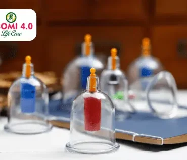 cupping treatment in Chennai