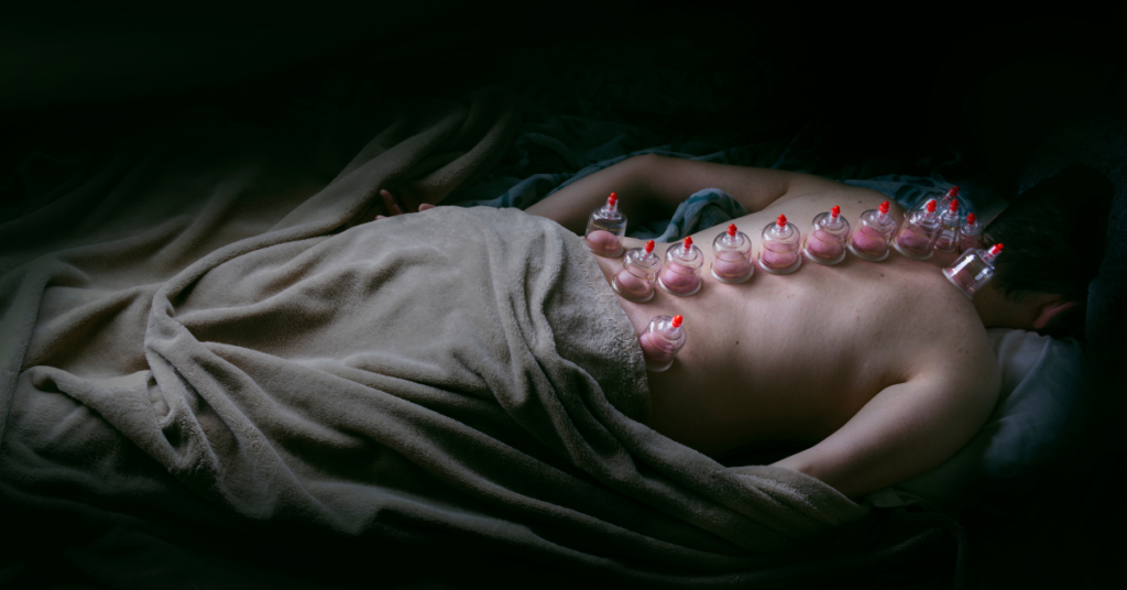 cupping therapy