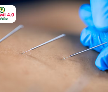 Acupuncture Treatment