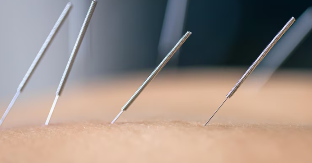 Acupuncture Treatment